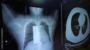 A detailed view of a medical monitor displaying chest X-ray and CT scan, suggesting an enlarged inspection of the lung tissue.
