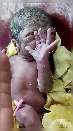 NICU Life: Collodion Baby with Club Foot | Gentle Nursing Care & Management 💖