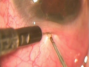 Buphthalmos Fugo Blade Filtration - Eyetube