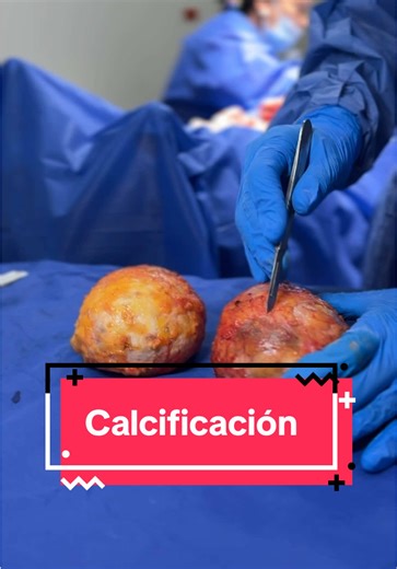 Recuerda hacerte revisión de tus implantes mamarios #viral #trending #antesydespues #tendencia #navidad