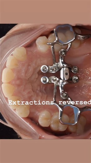 Dr. Svitlana Koval on Instagram: "Midfacial expansion after all four premolar extractions #drkovalorthodontics #reversingspaceloss #increadingairwaysize #airways #airwayorthodontics #expansion #adultexpansion #marpeface #marpeface™️ #marpe #fme #mse"