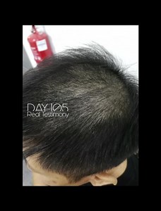 113K views · 558 reactions | The Most Effective Hair Growth Product...