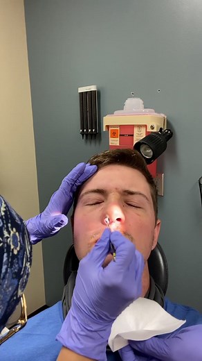 Septum Surgery: Silicone Stint Removal Process