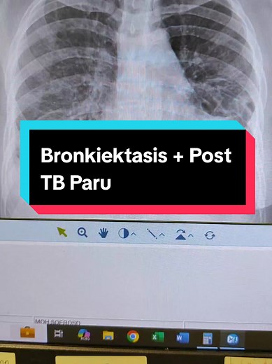 Bronkiektasis dan Riwayat TB Paru pada Wanita 33 Tahun