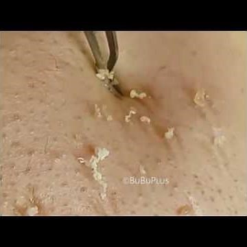 Επαγγελματική Λαβίδα Αφαίρεσης Μαύρων Στιγμάτων και Σμήγματος