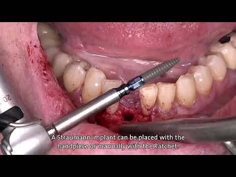 Dr. Stefan P. Hicklin: Straumann® BLT Ø 2.9 mm implant