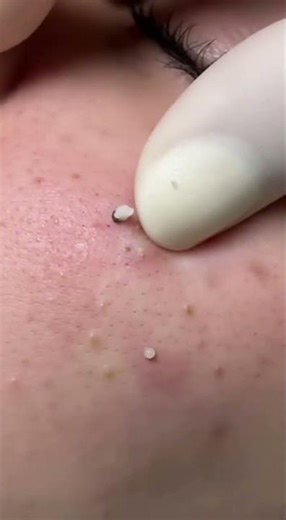 Extreme Close-Up Skin Care | Deep Pore & Cystic Acne Extraction Work
