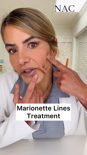 #marionettelines #marionettelinestreatment #marionettelinesfiller #marionettefiller #marionettebotox #daobotox #botoxtraining #fillertraining #drbitafarrell #naturalaestheticscenter