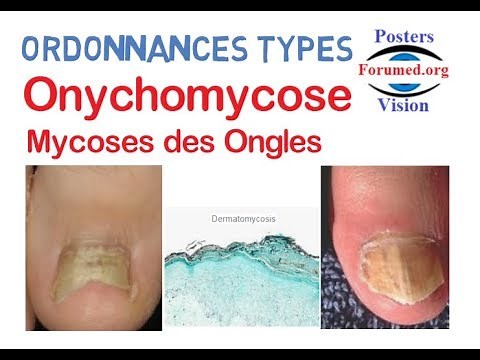Onychomycose traitement des Ongles infectés par les champignons Ordonnances Types