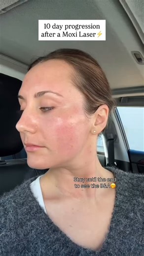 Soulshine Aesthetics on Instagram: "MOXI recovery, day by day. This video was captured by our client over 10 days following her MOXI treatment, and we’re so grateful she shared her experience with us. 🤍 MOXI is a gentle, non-ablative laser designed to improve: • skin tone and texture • sun damage and early pigment • overall skin clarity and brightness MOXI recovery is gentle and progressive. You may notice a bronzed appearance and small mends on the skin as it renews — without peeling or aggres