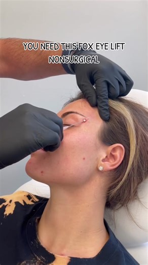 Nonsurgical Fox eye lift with mint PDO threads ftw 🪡🤩 #threadlift #foxeye #foxeyes #foxeyethreadlift #foxeyethreads #eyelift #medspanyc #doctorsoftiktok #facelift #nonsurgical #nonsurgicalfacelift #nonsurgicaltreatment #fyp #snatched #eyebrowtutorial #eyebrowlift