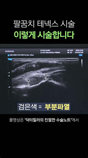 팔꿈치 혁신치료 '테넥스(TENEX)' 실제 시술법