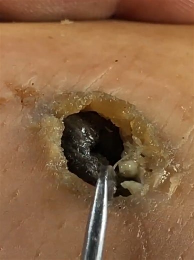 Professional pedicure treatment.#pimplepopping #oddlysatifying #asmr #skincare #viralvideo