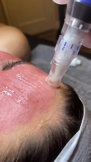 SkinPen® Precision Skin Treatment for Tightening, Brightening, and Lifting