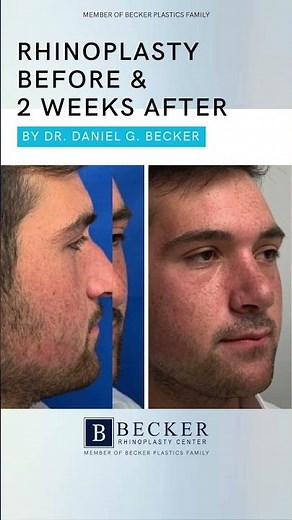 A Broken Nose Fixed Inside and Out 👃💨 | 2 Weeks After Rhinoplasty with Dr. Becker