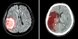 BIOTECH WEEK : Traitement de l’AVC hémorragique : un enjeu de santé publique