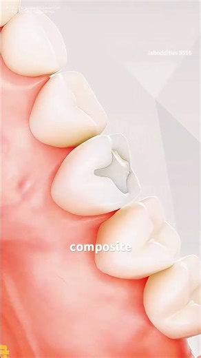 How Composite Filling Are Perormed (3D animation) #music #motivation #epic #like
