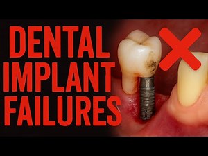 Why do dental implants fail?