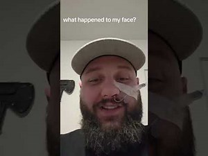 I had a rhino rocket inserted to my brain through my nose...