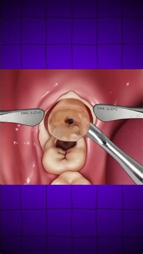 Comprehensive Guide to Tooth Extraction: Step-by-Step Procedure #Dentistry#ToothExtraction#Dental