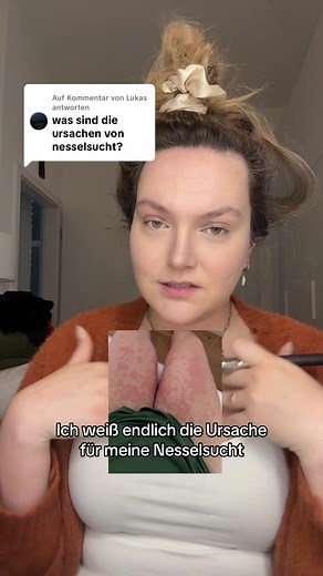 Tipps gegen Nesselsucht: Krankheit verstehen und handeln