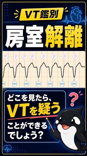 VT鑑別！見分け方！ポイントは「房室解離」！QRSに埋もれたP波を探してみて下さい！ #心電図 #検査技師学生 #心電図検定 #夜勤 #解説 #看護学生 #医学生