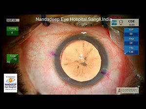 Live streamed Subluxated cataract, pupilloplasty for traumatic mydriasis Dr Sourabh D Patwardhan