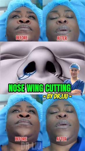 Dr Liu Vũ - Facelift & Rhinoplasty on Instagram: "🔥 NOSE WINGS REDUCTION $499 🔥 ✨ Narrows wide nostrils → Creates a **more delicate and refined nose shape**, especially from the front view. ✨ Improves facial balance → Brings harmony between the nose, lips, and chin, making the entire face look softer and more proportional. ✨ Permanent and natural results → Once healed, scars are minimal and hidden, leaving a natural, balanced appearance that lasts. #fyp #plasticsurgery #viral #facelift #smasfa