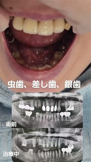 本日は新潟県からのモニター様がカウンセリング当日セラミック矯正スタートです。下の前歯の虫歯、銀歯、セラミックのやり直しなどのお悩みを一気に22歯仮歯で激変していきました