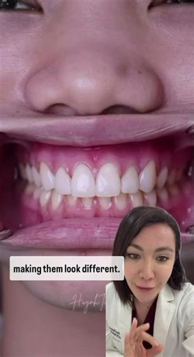 Placing On The No Prep Veneers!