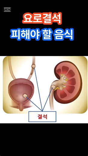 요로 결석 피해야 할 음식