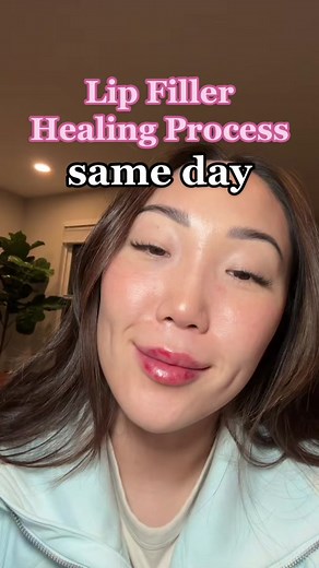 Lip filler healing process - 1 full syringe done in 1 session. same day - bruising significant swelling are expected. You should be fully healed in 2 weeks. Plan accordingly! 💋 #lipfiller #lipfillerhealingprocess #dermalfiller #cosmeticinjector #dermatologyPA #lipfillerjourney