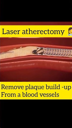 Laser atherectomy remove plaque build -up from blood vessels#laseratherectomy#laser #lasertechnology