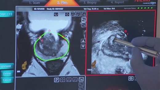 Clinical trial by University Hospitals Seidman Cancer Center in Cleveland leads to practice-changing precision prostate cancer therapy