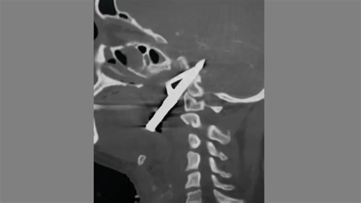 Penetrating Brain Injury: Good Outcomes Achievable Even in Grave Cases