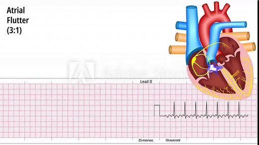 Atrial Flutter 3:1- ECG and Heart Conduction - Electrocardiogram Medical Animation