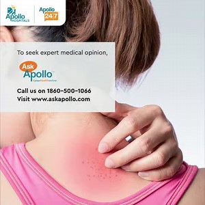 Sweet syndrome is a rare skin condition. It causes painful small red bumps that appear on your arms, face, and back. To know more about Sweet Syndrome, Click the link below: https://healthlibrary.askapollo.com/sweets-syndrome-symptomscauses-types/ To book an appointment, call us on 1860 500 1066 or visit www.askapollo.com #apollohospitals #askapollo #sweetsyndrome #skincondition #infection #skindamage | Apollo Hospitals