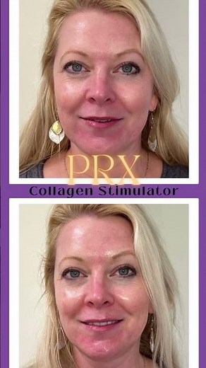 Revitalize Your Skin with PRX-T33: The No-Needle Bio-Revitalizer 🌟 Discover the future of skincare