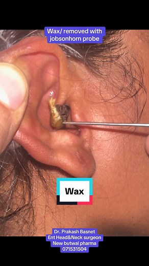 Uso de ciprofloxacina en gotas para oídos