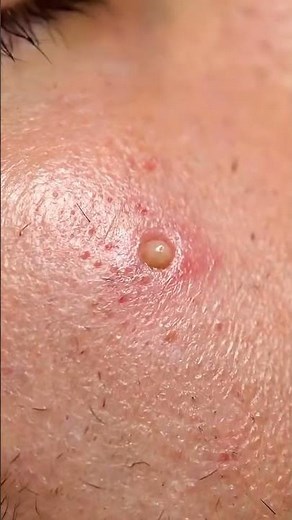 Real Pimple Removal with Loop Tool — Close-Up #shortsvideo