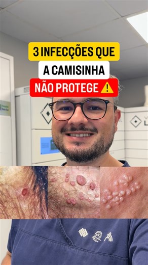 Dr. Marcelo Schneider Goulart - Urologista on Instagram: "Proteção da Camisinha 🛡️ Alta Proteção (Fluidos) 💧 ✅ HIV, Gonorreia, Clamídia, Hepatite B. Proteção Parcial (Pele a Pele) 🤝 ⚠️ Sífilis, HPV, Herpes, Chancro. (Protege apenas a área coberta pelo látex!) Dica de Ouro ✨ 🚫 Fuja da camisinha de “pele de cordeiro” (lambskin). Ela não barra vírus. ✔️ Use apenas látex ou sintéticos de forma consistente. A prevenção é o melhor caminho para sua saúde! 🩺 @drmarcelosgoulart"