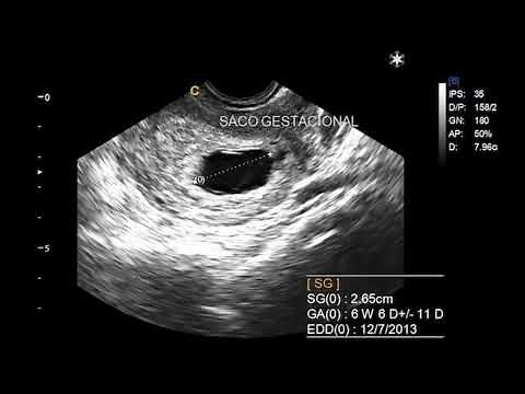 MEDIDA DEL SACO GESTACIONAL POR ULTRASONIDO