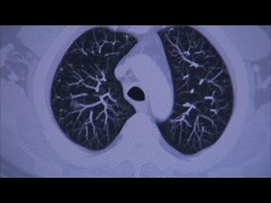 Lung Cancer Screening - Mayo Clinic