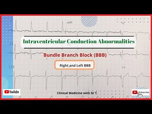 The ECG Series//Intraventricular Conduction Abnormalities//Bundle Branch Block//