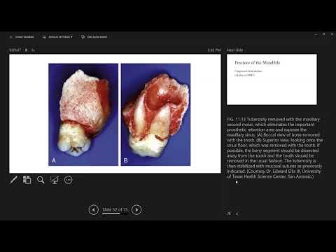 Post-Extraction Patient Management - Part 3