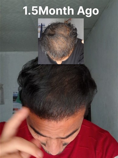 Understanding Finasteride: Side Effects and Hair Thickening