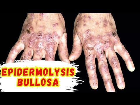 Epidermolysis Bullosa: The Butterfly Skin Disease🧑🏻‍⚕️😱