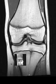 How to Read Knee MRI scan | First Look MRI
