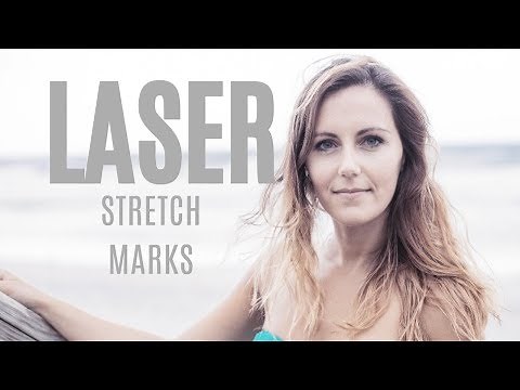 How-to: Stretch Mark Removal With Laser Treatment