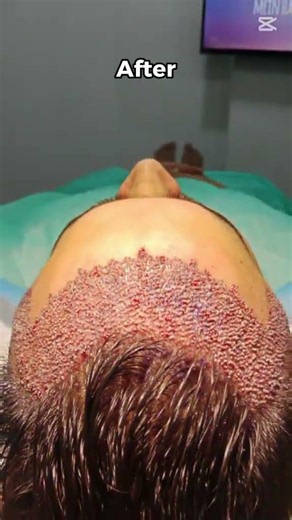 Hair world Hair PRP injection Hair transplant hair world 🌎🌍🌎🌍 🌍🌎